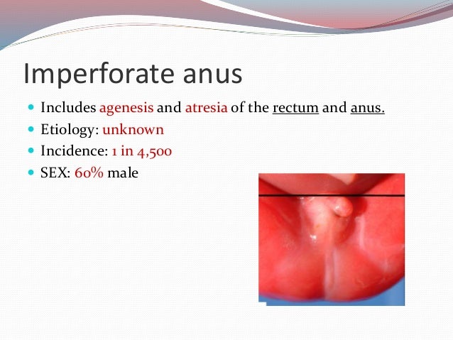 History of imperforated anus Erotic love rated story x
